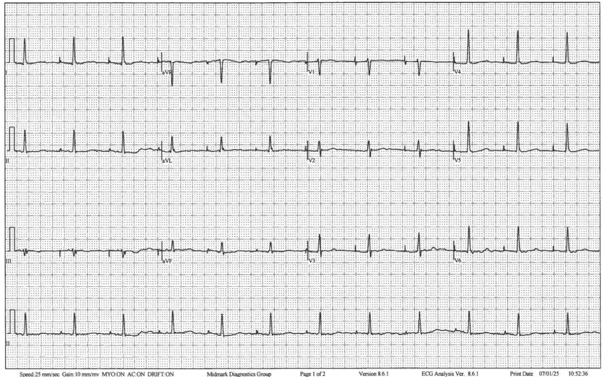 This EKG was taken from a 68-year-old male who underwent electrical cardioversion for atrial tachycardia/flutter a couple of weeks ago. He has a dual chamber PM. He is feeling well...