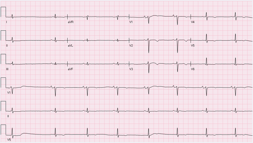 This EKG was taken from a 75 year-old male with paroxysmal AF. He is on longer acting metoprolol 50 mg. You noticed that his heart rate is on the slow side, but his blood pressure is normal and he...