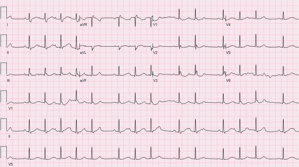 What is the cause of the irregularities in this EKG?