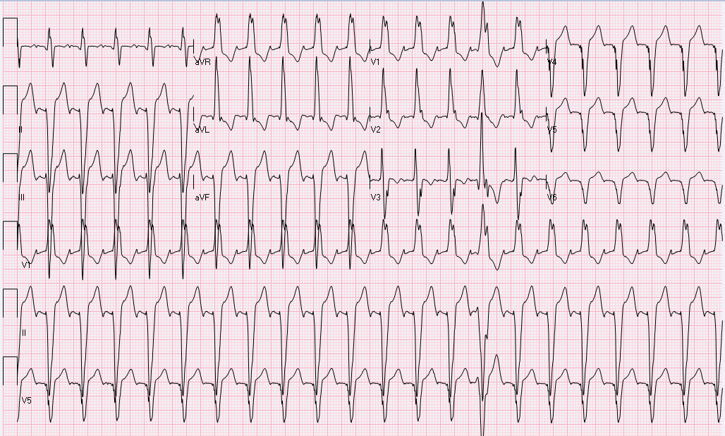 A 55-y-o male with h/o stroke. Found to be aphasic awake but non-communicating. HR: 130s, and BP: 160/80. No more history obtainable. 