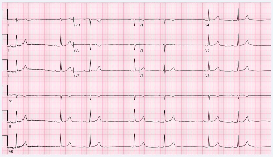 This EKG was done on an 82-year-old male who is asymptomatic. You checked his pulse in the clinic and was found to be irregular, therefore this EKG was done.Was the interpretation and next...