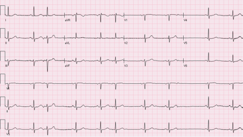 A 74-year-old woman presents to the ED with an irregular pulse and bradycardia.What is causing her bradycardia?