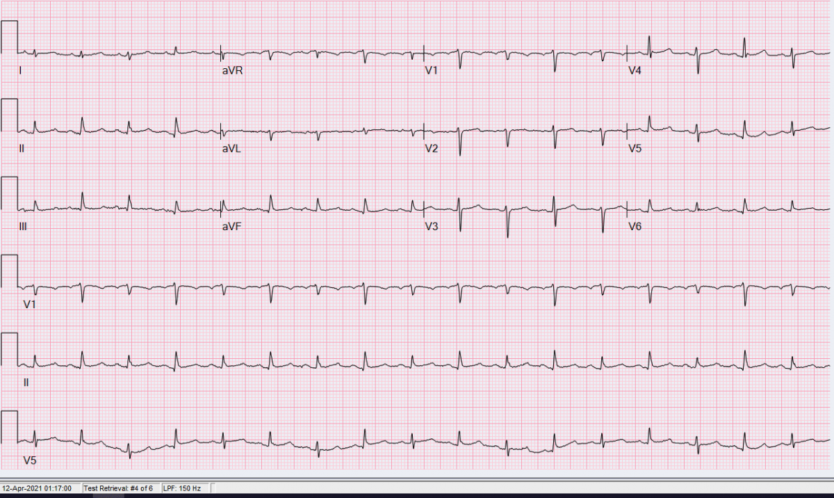 This is a 56-y-o-Hispanic man in ER with SOB. His EKG is "classical" for what diagnosis?