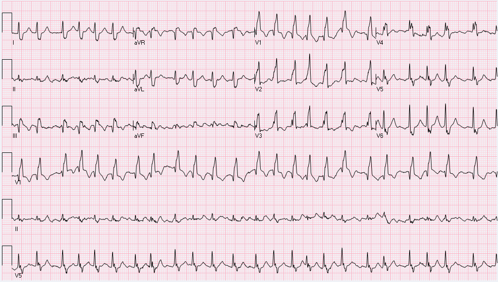 This EKG was taken from an 83-year-old female in the hospital with UTI. She reports shortness breath and palpitations. What is the rhythm interpretation?