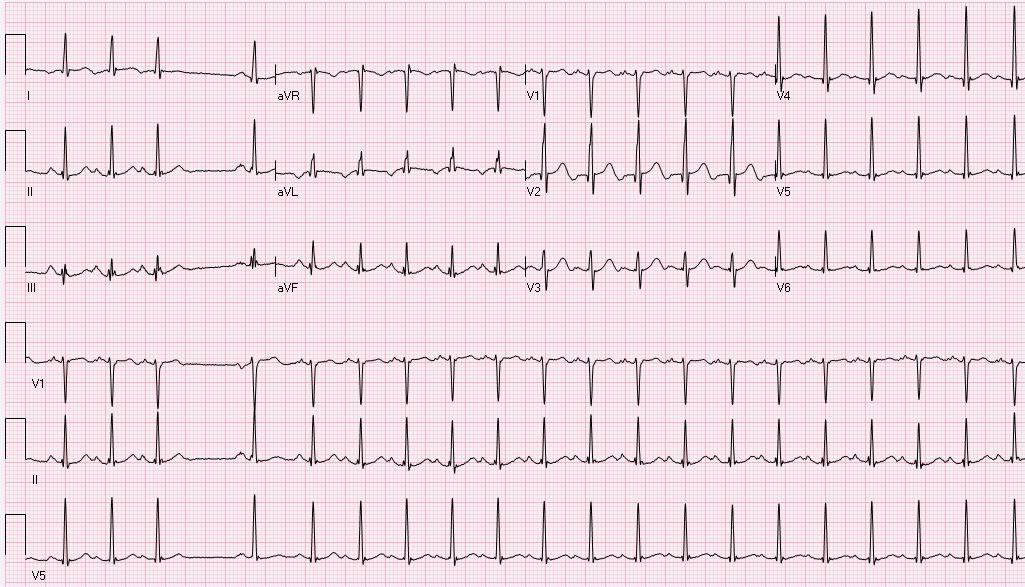 This EKG was done on a 37-year-old male who was in the ER for a noncardiac problem.What is the rhythm diagnosis?