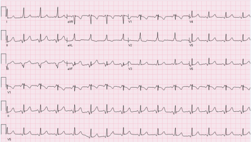 This is a 23-year-old who was seen in the emergency room with chest pain and occasional dizziness.    What is the overall assessment of her EKG, and what to do next? 