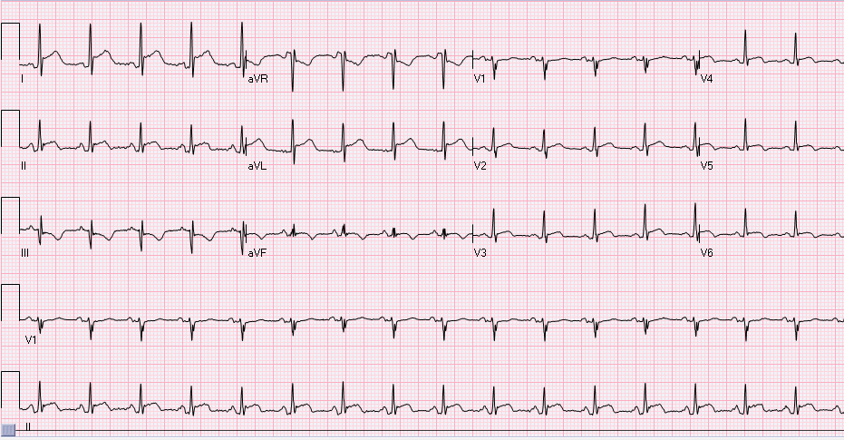 This is a 65-year-old male, otherwise healthy who presented to the ED with chest pain and was found to have elevated troponin around 622 ng/L (high sensitivity troponin).Based on the EKG findings,...