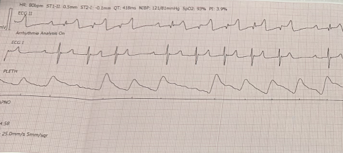 Bite-sized EKG #3: Basic Cardiac Physiology!