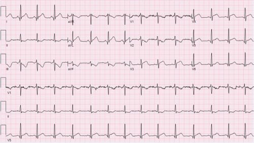 Bite-sized EKGs #7: Is this a STEMI or NOT?