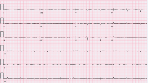 Bite-Sized EKG #9 - What's first thing comes to mind when you see this?