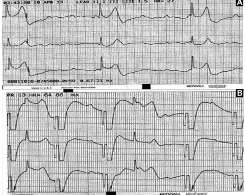 ECG of the Month: Can We Always Trust External Pacemakers?