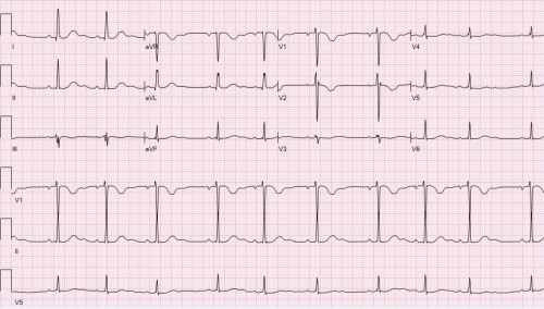 Bite-sized EKG #1: A pregnant young lady!