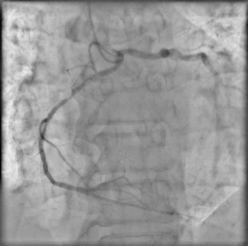 RCA from left coronary cusp