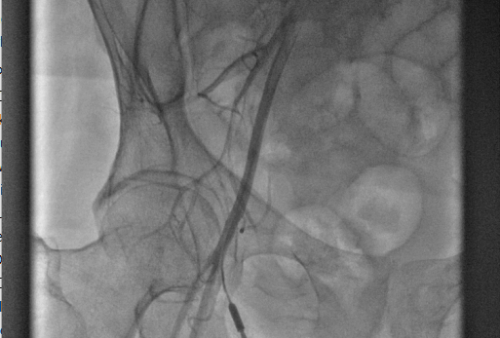 Angiography - Safe Femoral Access