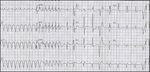 Bite-Sized EKG #5: Painless!